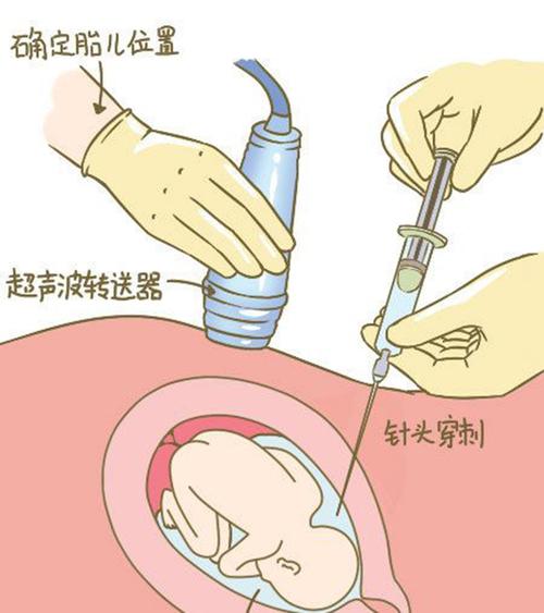 金华羊水孕期亲子鉴定